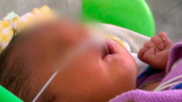 Conmoción en Perú por el nacimiento de un bebé con dos narices