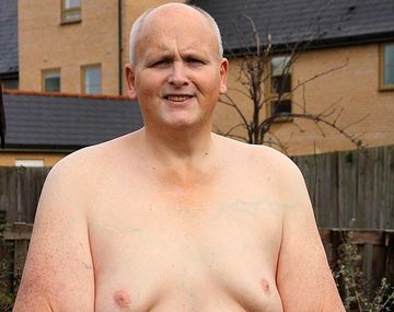 Logró bajar 292 kilos y ahora tiene piel de sobra