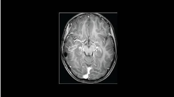 Una chica de seis años no podía parar de reírse debido a un tumor cerebral