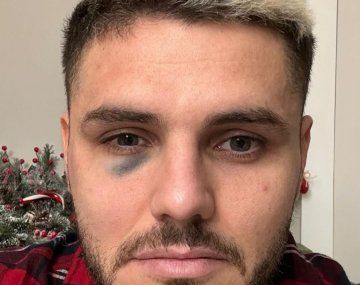 Escándalo: Icardi terminó con un ojo morado y denunciaron al VAR