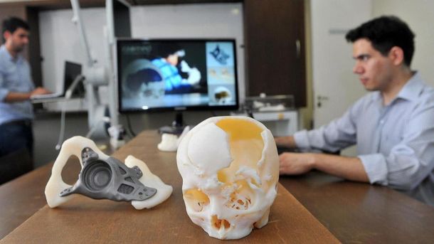 Cada vez más países usan implantes fabricados con impresora 3D
