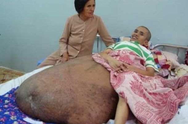 Tumor