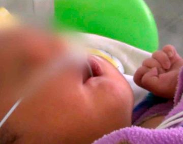 Conmoción en Perú por el nacimiento de un bebé con dos narices