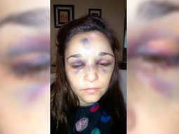 Carla Pereyra fue brutalmente golpeada por su novio Carla Pereyra fue brutalmente golpeada por su novio