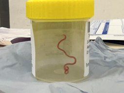 Una mujer tenía un gusano vivo en el cerebro