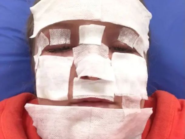 Increíble: así quedó una influencer después de broncearse en una cama solar rota