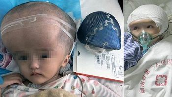 por primera vez, trasplantan craneo hecho en impresora 3d a una nena de tres anos por primera vez, trasplantan craneo hecho en impresora 3d a una nena de tres anos