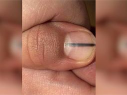 Fue a hacerse la manicura y le detectaron un melanoma