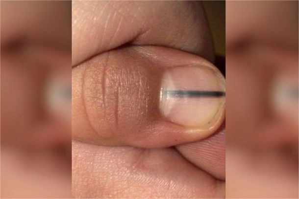 Fue a hacerse la manicura y le detectaron un melanoma