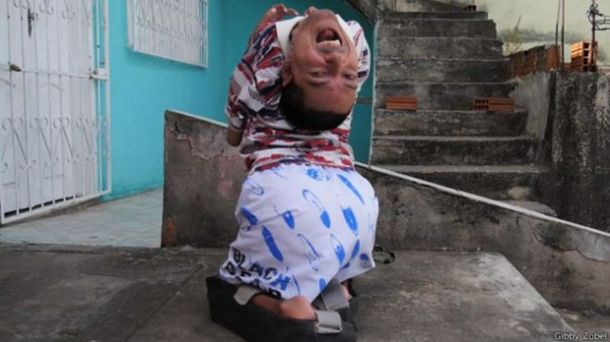 La conmovedora historia del hombre que nació con la cabeza al revés