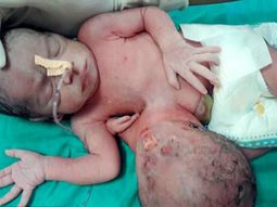 Además de una cabeza en el abdomen, la bebé tenía una tercera mano