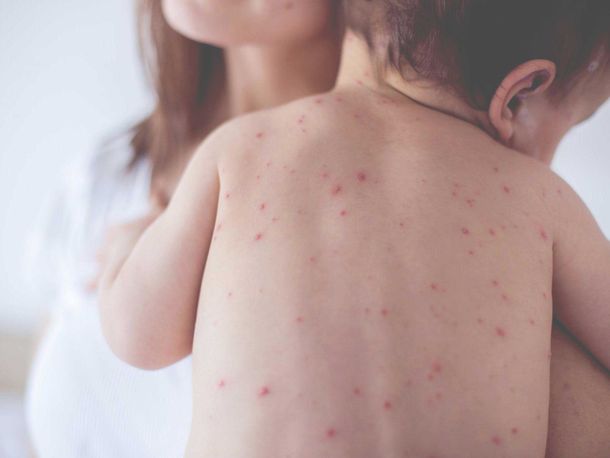 Alerta sanitaria por Sarampión: cuáles son sus síntomas y cómo prevenirlo
