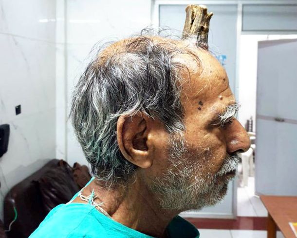 Shyam Lal Yadav fue operado de un crecimiento en la cabeza