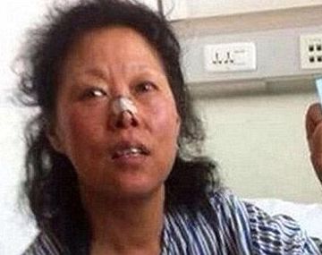 Una mujer vivió 48 años con una bala en la cabeza