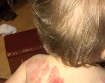 Fue a buscar a su hija a la guardería y descubrió que tenía más de 25 mordidas