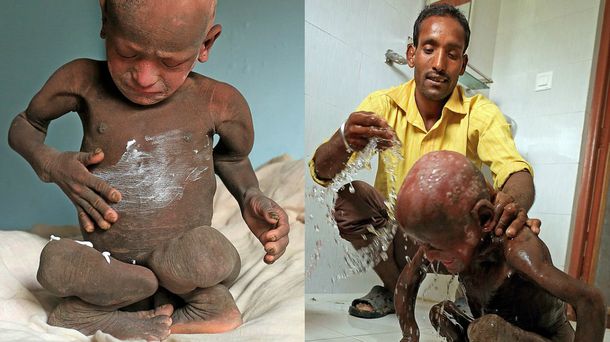 El extraño caso del nene que se está convirtiendo en piedra