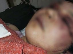 El drama de una mujer en Comodoro: su ex novio la desfiguró con un hierro y teme por su vida
