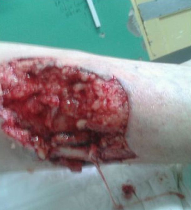 Un pitbull le arrancó parte de una pierna a una mujer en La Pampa