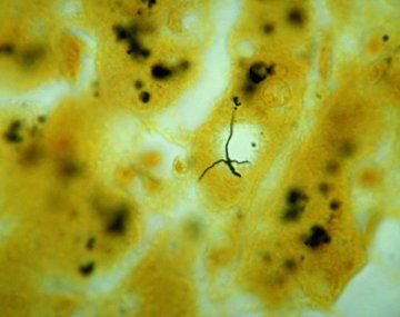 Intoxicación en Berazategui: confirmaron los diagnósticos de los muertos e internados