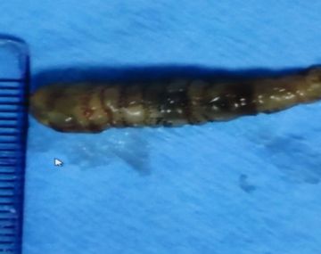 Así le extraen un gusano del ojo de un chico