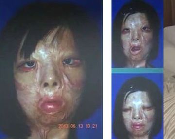 Una chica de 17 años se hizo un trasplante de cara