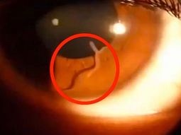 video: mira el gusano que tenia una mujer dentro de su ojo video: mira el gusano que tenia una mujer dentro de su ojo