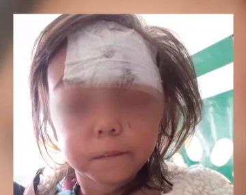 Un pitbull le desfiguró la cara a una nena de 2 años en Merlo 