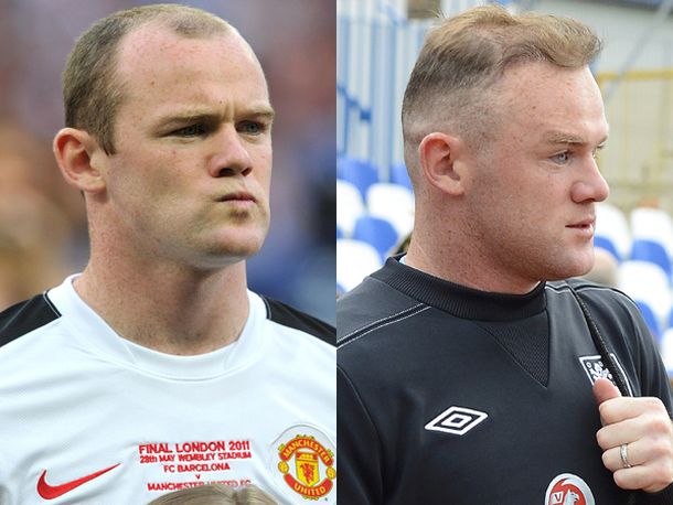 Wayne Rooney se hizo un segundo retoque capilar