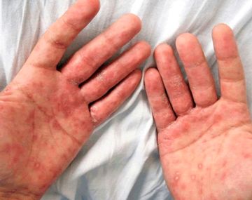 Preocupación en la comunidad médica por el aumento de sífilis