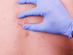 Vinculan culebrilla con riesgo de infarto y ACV