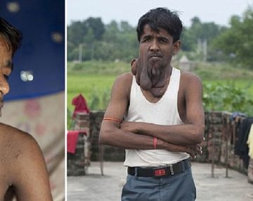 Logran rehabilitar al hombre elefante en la India