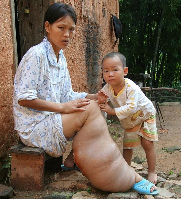 El pedido desesperado de la mujer con pata de elefante