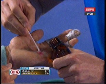 Así quedó la mano de Nadal tras destrozar a Federer