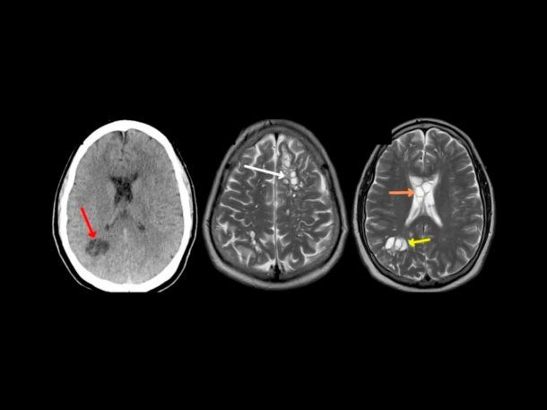 Le dolía la cabeza y el diagnostico fue devastador: Había un gusano