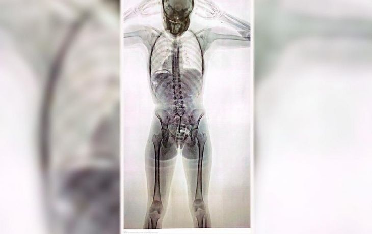 Detuvieron a una joven con 78 cápsulas de cocaína en el cuerpo