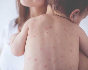 Alerta sanitaria por Sarampión: cuáles son sus síntomas y cómo prevenirlo