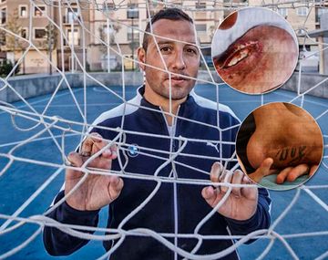 El calvario de una figura: no puede jugar y le injertaron piel en el tobillo