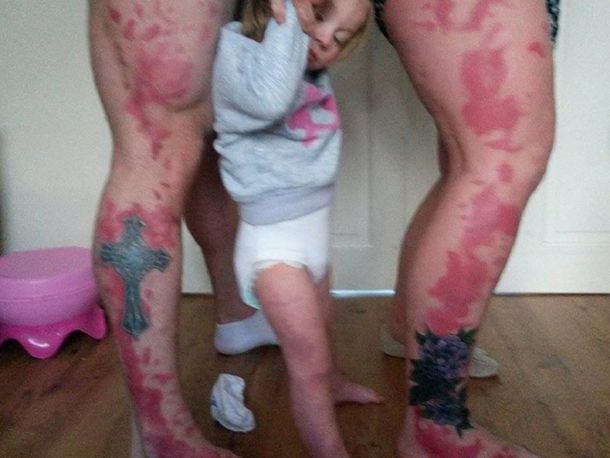 Se tatuaron las manchas de nacimiento de su hija para que no se sienta mal