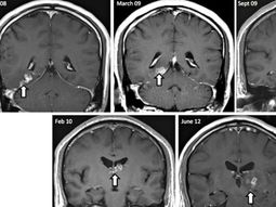 un hombre vivio mas de 4 anos con un gusano dentro de su cabeza un hombre vivio mas de 4 anos con un gusano dentro de su cabeza
