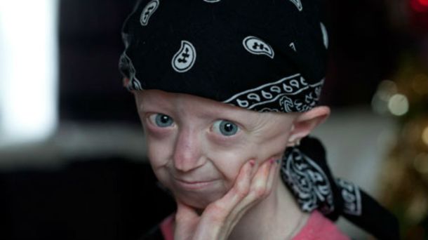 A los 17 años murió la adolescente más vieja del mundo