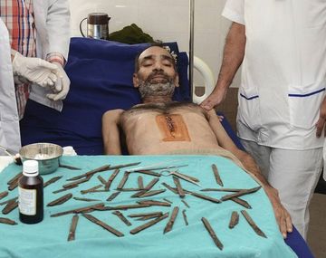 Fue al médico por dolor abdominal y tenía 40 navajas