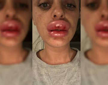 Fue a una fiesta cosmética y terminó con el labio deforme