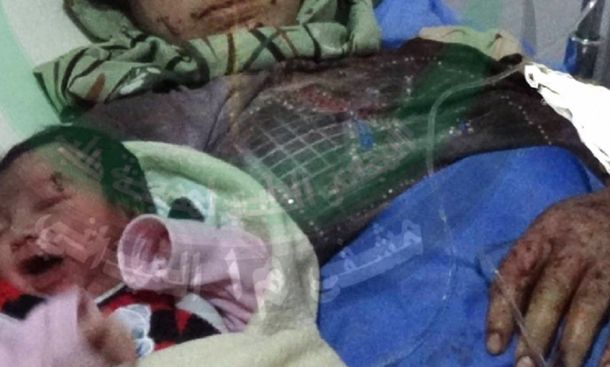 Una beba siria nació con la herida de una bala en la frente