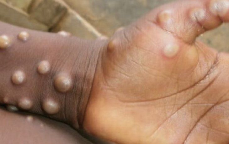 Alerta por la viruela del mono en Europa: casos confirmados en Reino Unido, España y Portugal