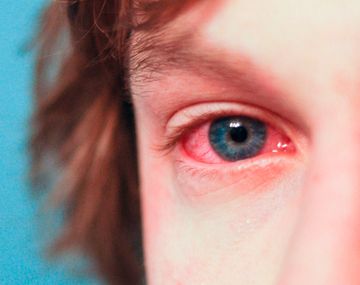 Alertan por una conjuntivitis que puede durar hasta un mes y dejar secuelas