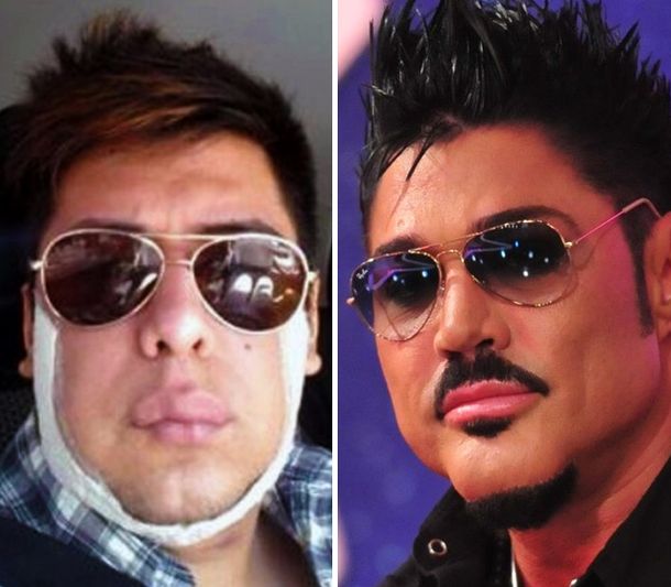 El fan de Wanda Nara tras los pasos de Fort: arrancó con las cirugías