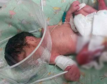 Intentan salvarle el piecito a la beba que fue quemada con un caloventor