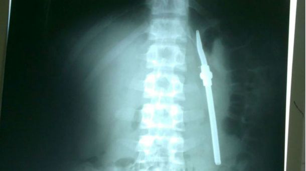 Un preso tomaba mate y se tragó una bombilla: creen que lo hizo para fugarse