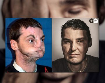 Un gran cambio: de un trasplante de cara a la portada de una revista de moda