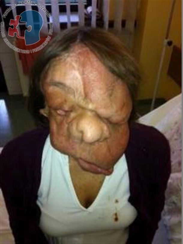 Queda desfigurada por un tumor y le trasplantan la cara